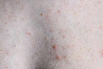 Close up image of a little boy's body suffering severe urticaria, nettle rash also called hives