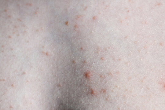Close up image of a little boy's body suffering severe urticaria, nettle rash also called hives