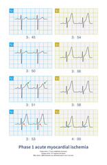 Male, 53 years old, chest pain for 3 months. The Holter captured the onset of myocardial ischemia, which was characterized by the towering T wave and the deformation of the end of QRS wave.