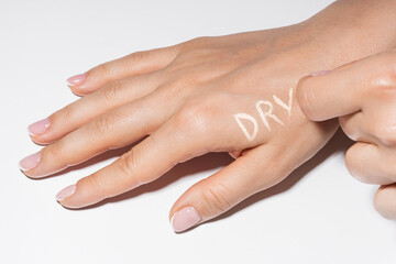 Female hands with itchy skin and DRY lettering on it
