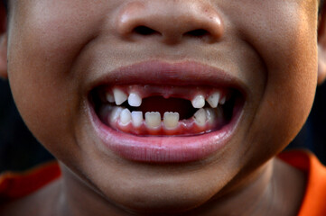 Children's front teeth erupt at age 7, the concept of dental health care for children.