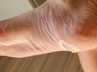 Close-up of a male foot with peeling skin. Avitaminosis. Disease. Dry problematic skin on the feet. Health care concept.