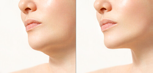 Female double chin before and after correction. Correction of the chin shape liposuction of the...