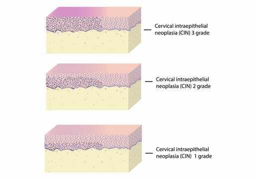 Histology of intraepithelial neoplasia of cervix uteri under a microscope, vector, illustration, set