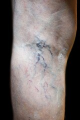 Prominent veins visible through the thin skin of Asian woman.