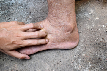Pitting edema of lower limb. Swollen leg of Asian man.