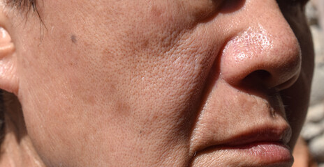 Small brown patches called age spots on face of Asian elder man. They are also called liver spots,...