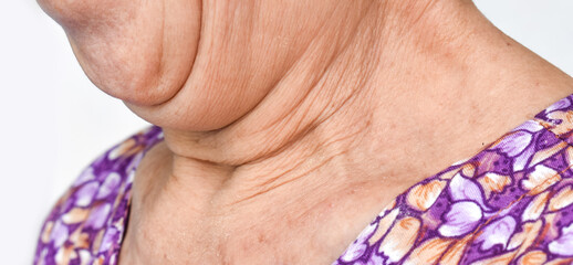 Aging skin folds or skin creases or wrinkles and neck fat pocket of Asian Chinese old woman.