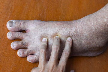 Pitting edema of lower limb. Swollen leg of Asian man.