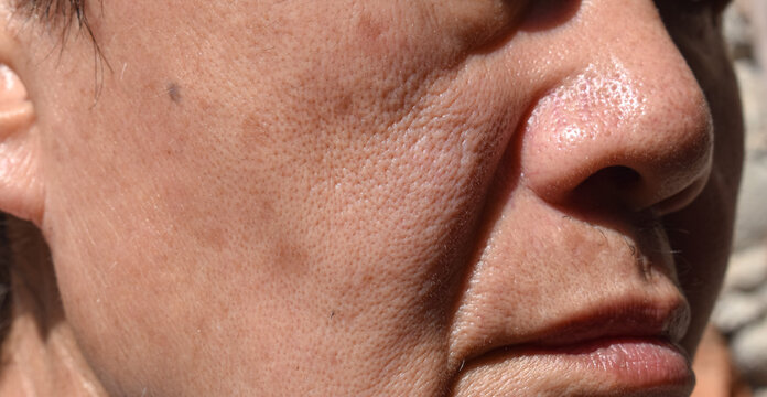 Small brown patches called age spots on face of Asian elder man. They are also called liver spots, senile lentigo, or sun spots.