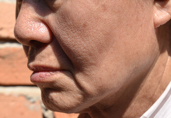 Fototapeta premium Enlarged pores in oily face of Asian, elder man with skin folds.