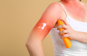 Woman with red sunburned skin applying cream against color background