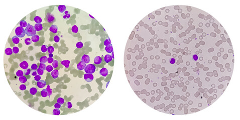 Photo college of Acute myeloid leukemia (AML) is a type of blood cancer. Microscopic image of...