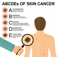 Diagnosis of skin cancer. Melanoma warning signs. Dermatological screening. UVB prevention of squamous cell treatment. Basal test. ABCDEs of skin cancer screening. Man back view
