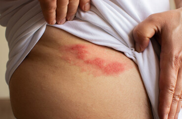 Shingles (herpes zoster) blister skin rash