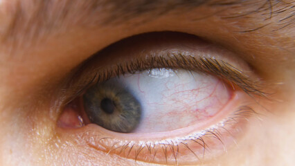 Close-up of a blue human eye looking down to the left. Red capillaries on the eyeball. A tired...