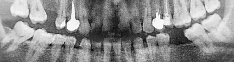 x-ray of a man's jaw 360 degrees. very high noise. two implants. Banner for insertion into site. Horizontal image.