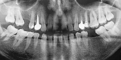 x-ray of a man's jaw 360 degrees. very high noise. two implants. Banner for insertion into site. Horizontal image.