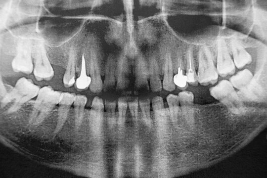 x-ray of a man's jaw 360 degrees. very high noise. two implants. Horizontal image.