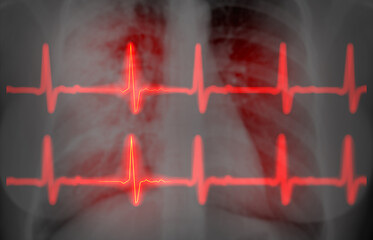 CHEST X-ray with EKG 3D rendering image  for diagnosis of vessel coronary artery stenosis .