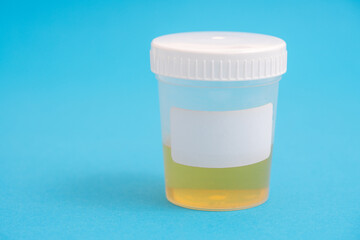container with a urine sample for laboratory analysis