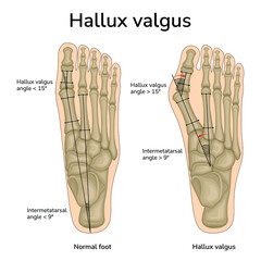 An illustration of the location of the bones in a healthy foot and hallux valgus. The angles of the bones relative to each other are indicated