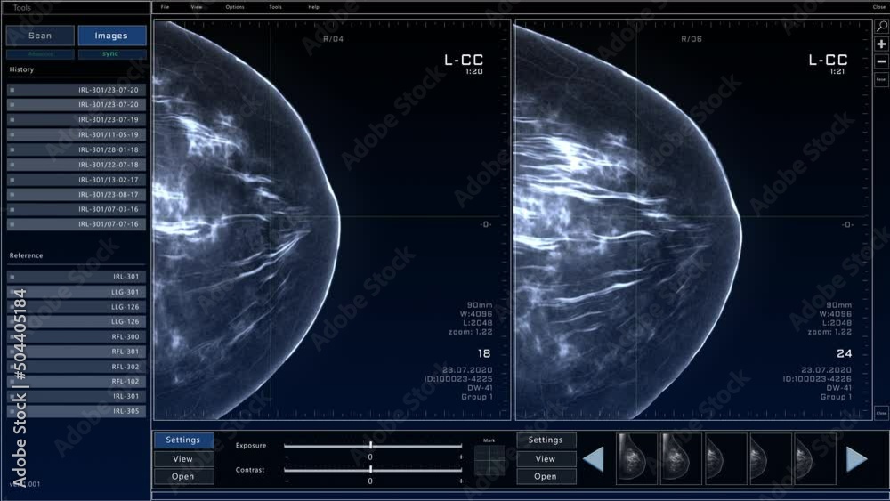 Leinwandbilder Mammogram Breast Scan Mock-up with Multiple Windows and Data. Medical Research Environment Software with X-Ray Scan Results for Computer Displays and Laptop Screens.