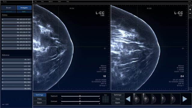 Mammogram Breast Scan Mock-up with Multiple Windows and Data. Medical Research Environment Software with X-Ray Scan Results for Computer Displays and Laptop Screens.