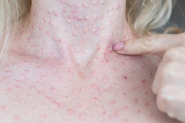 Real biorevitalization of the skin on a white background. Traces of injections of biorevitalization...