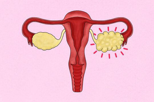 Female reproductive system illustration. Polycystic ovary syndrome