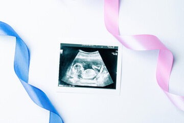 Ultrasound picture pregnant baby photo. Blue, pink ribbon with ultrasound pregnancy image on white...