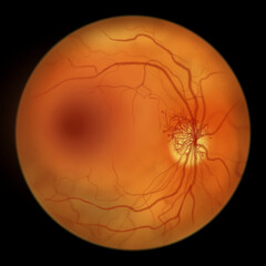 Diabetic retinopathy, ophthalmoscopic diagnosis, illustration