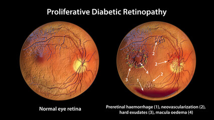 Diabetic retinopathy, ophthalmoscopic diagnosis, illustration