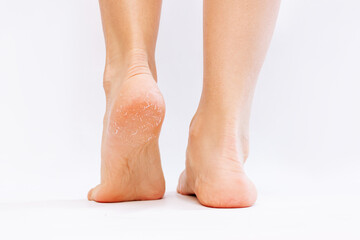 Female feet with cracks and peeling on heels isolated on a white background. Fungal skin...