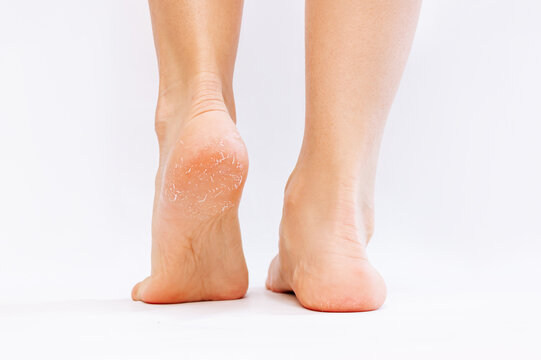Female feet with cracks and peeling on heels isolated on a white background. Fungal skin infections, allergic diseases, eczema, psoriasis, hyperkeratosis, vitamin deficiency, avitaminos