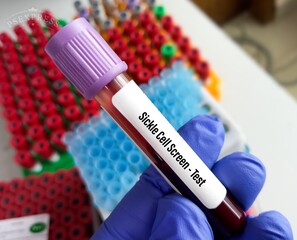Blood sample tube with blood for Sickle Cell Screen -Test. Sickle cell blood test, abnormal...