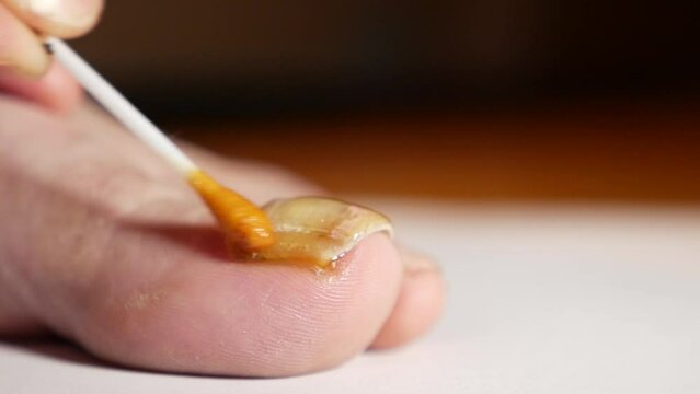 Apply the propolis solution on the nail affected by the fungus. Unconventional methods of nail fungus treatment.
