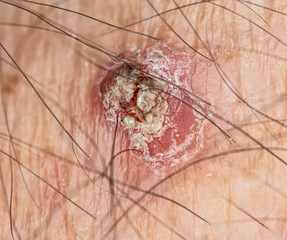 Basal cell or squamous cell carcinoma on sun exposed skin