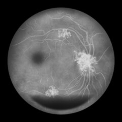Naklejka na ściany i meble Diabetic retinopathy, ophthalmoscopic diagnosis, illustration