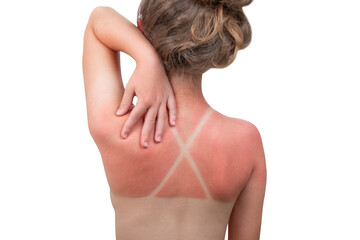 Fototapeta premium Sunburn. Girl got a Sunburn. Red painful skin on back that feels hot to the touch after beach visits. Use Sunscreen or UV protection cream. Summer vacation on ocean beach. White Isolated background.