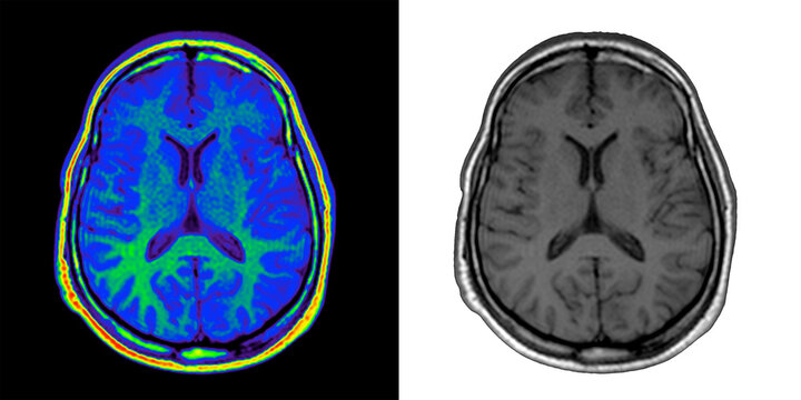 Brain scan. Brain mri. Brain blue. Brain Magnetic resonance scans. blue, green and grey. White and blak background.