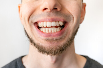 Close up of young man's face with crooked teeth. Teeth before install braces. Teeth need ortodonti