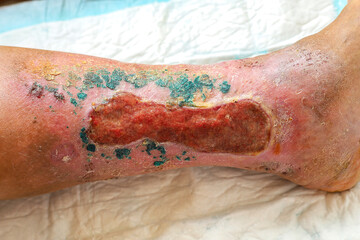 trophic ulcer of the skin in the lower leg in the granulation stage. - obrazy, fototapety, plakaty