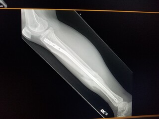 Right tibial fracture with internal fixation hardware