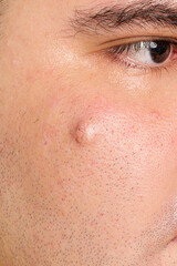 Sebaceous cyst on man face. Close up cyst on face.