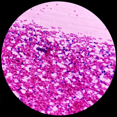 Chronic granulomatous inflammation with tuberculosis, vertebral and abdominal mass cytology, show epithelioid cells, lymphocytes, histiocytes.