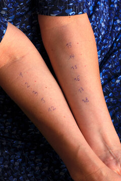 Hands of woman with allergy test numbers