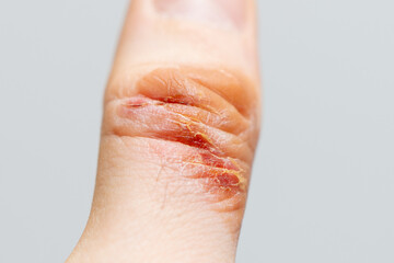 Chemical burn of a thumb finger. Household burn. An open deep wound. Damaged epidermis. Regeneration process. Macro view.