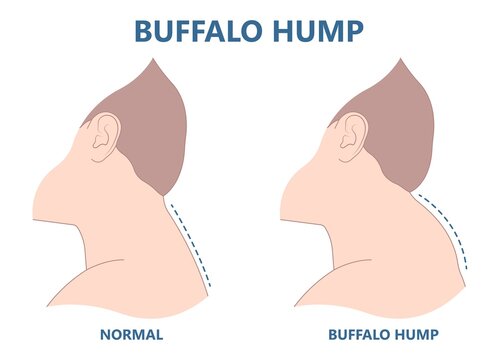 buffalo dowager's hump head bad poor women spine pad excess shape High level tumor cysts side effect body bone long term use curved muscle surgical diet Back sign
