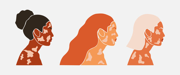 Set of abstract silhouette of beauty women with white pigmentation . Support awareness about chronic skin disorder. World Vitiligo day. Diversity tolerance. Fashion paper cut vector illustration
